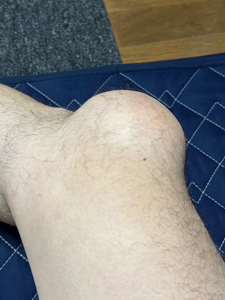 CurlyMatrix's tweet photo. 膝に水が溜まってやべぇ。
明日抜いて来ます。 https://t.co/lO9XSf5TbP