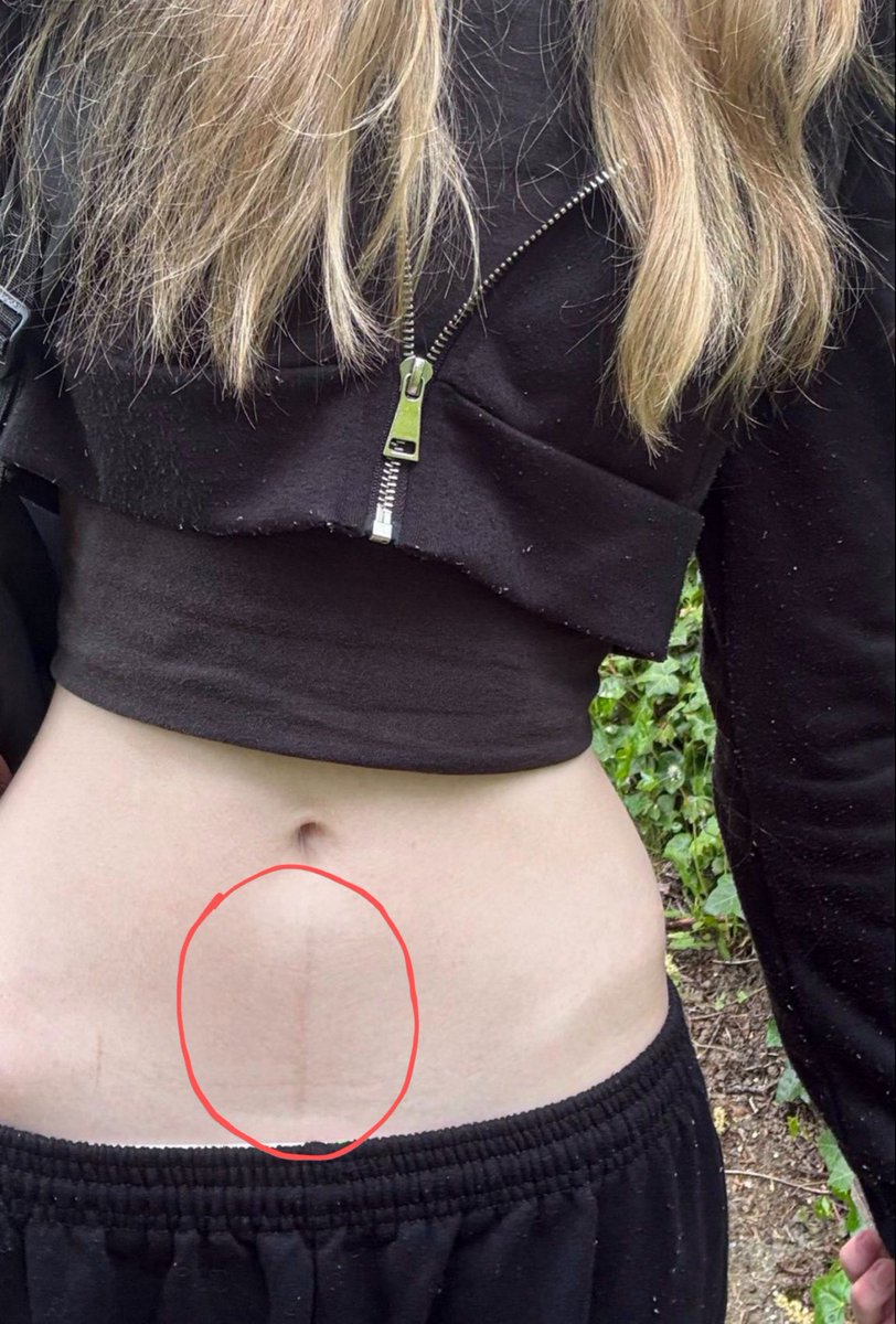 Iconiczar's tweet photo. She has these lines on her stomach, but what are they? Is there any specific reason for this mark or is it just like that? https://t.co/ZmgrfCM1m3