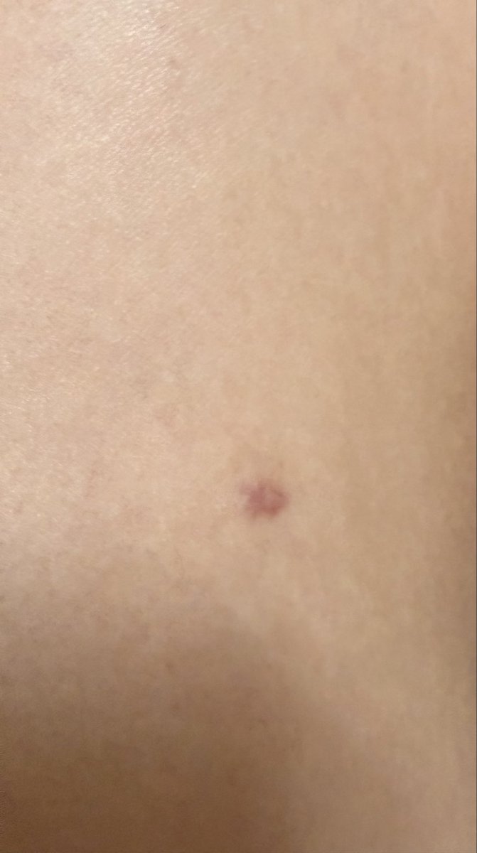 pitapitatapioka's tweet photo. 【太もも脂肪吸引4ヶ月の傷跡】

あんまり目立たないけど、ケロイドなりやすいから、中々消えない😭
太もも内側の膝に近いところに左右非対称にあります🥲(画像3枚目イメージ)
左右非対称なのが、聞かれたら言い訳しずらくて困る汗
保湿頑張ります！ https://t.co/np91C51TMf