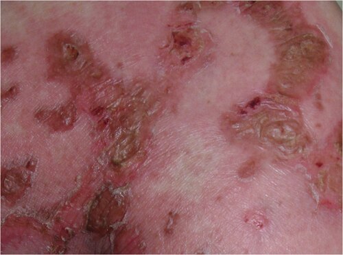 AkhshayaaG's tweet photo. 🤔 Would you recognise this rash?
 Necrolytic migratory erythema is the classic cutaneous manifestation of glucagonoma syndrome. Although rare, it often provides the earliest clue to the diagnosis. Rash + hyperglycaemia -- think beyond the skin!! https://t.co/pNC9UiKiu7