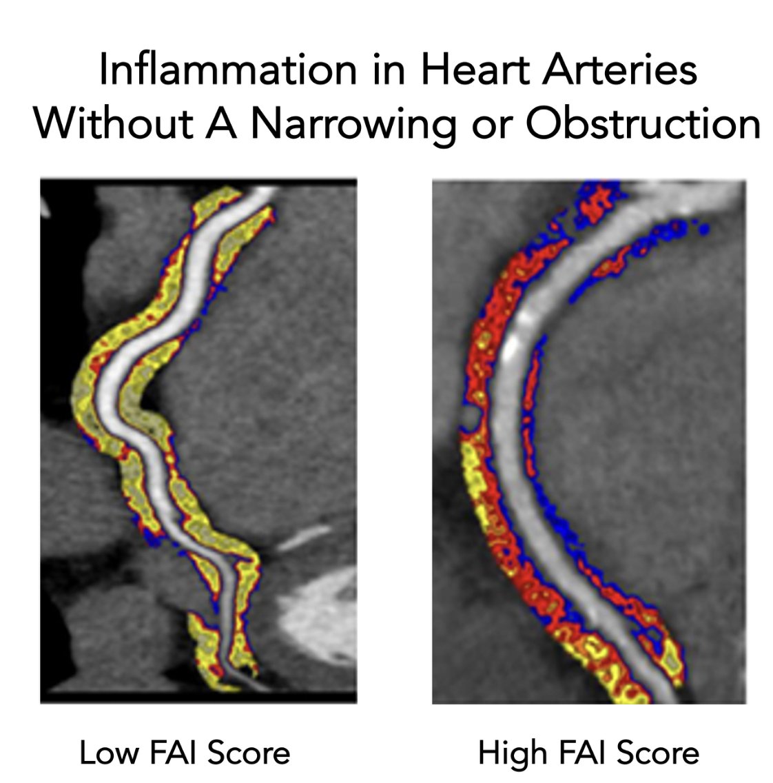 EricTopol's tweet photo. The first AI to quantify coronary artery inflammation was approved by the FDA yesterday @CaristoHeart 
This is an important step forward for preventing heart disease that I've written about
https://t.co/foSaaTYmNw https://t.co/OBUNHyPMIE