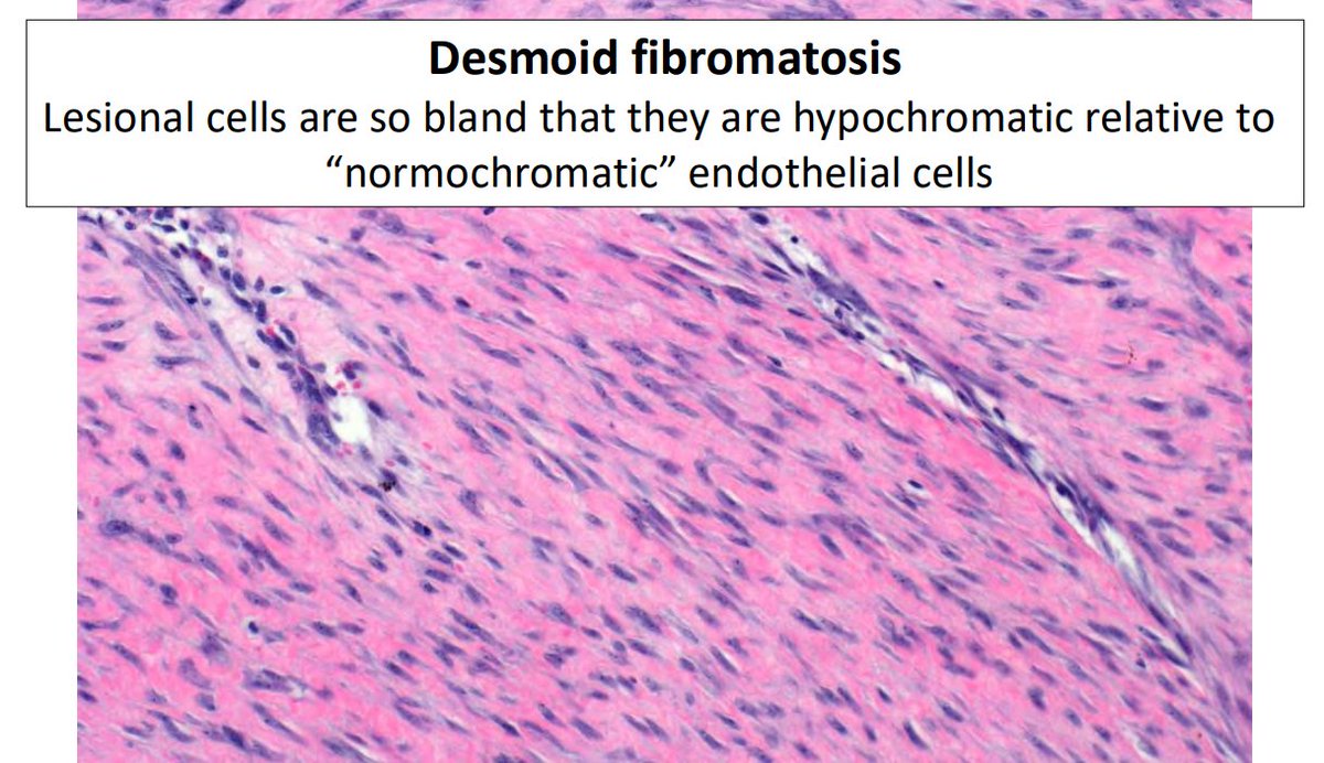 Janiranavarro's tweet photo. "Common" bland spindle cell lesions of the breast
Desmoid Fibromatosis

- Typically non-syndromic in breast
- Clinically and radiographically mimics carcinoma
- Trend towards conservative, non-operative approach with consideration of tyrosine kinase inhibitors
- β-catenin positive (up to 70%), but metaplastic carcinomas and fibroepithelial lesions may also show nuclear β-catenin labeling; always include cytokeratin IHC

Dr. Cimino-Mathews #USCAP #pathology #PathX #PathTwitter #Breastpath
