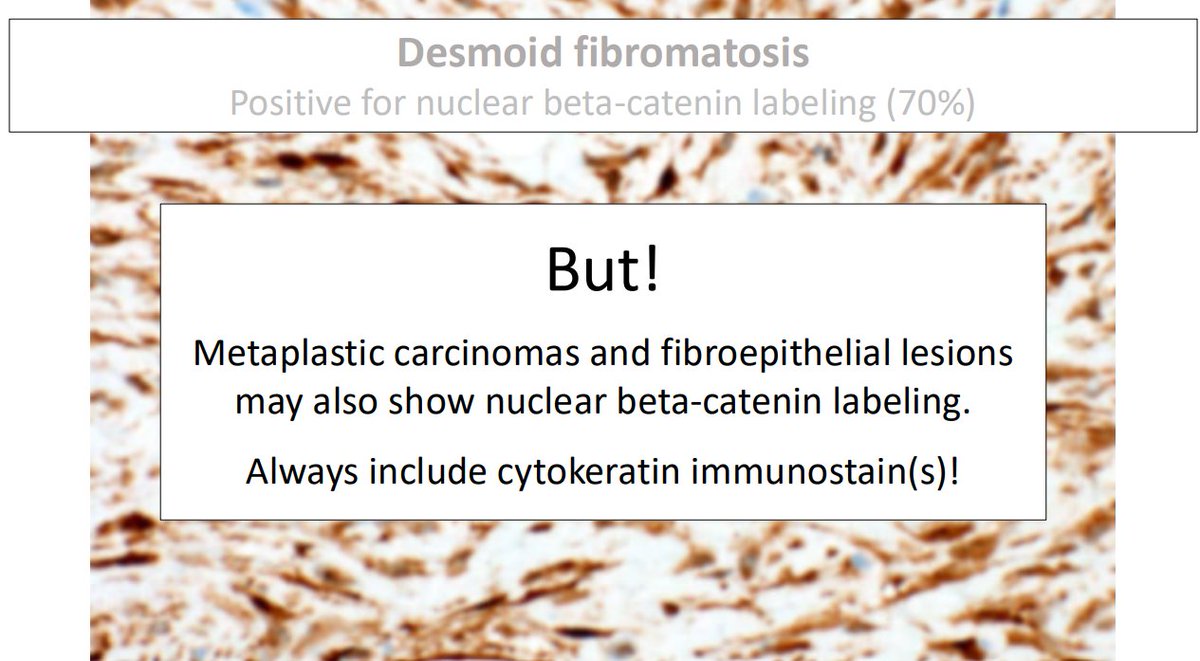 Janiranavarro's tweet photo. "Common" bland spindle cell lesions of the breast
Desmoid Fibromatosis

- Typically non-syndromic in breast
- Clinically and radiographically mimics carcinoma
- Trend towards conservative, non-operative approach with consideration of tyrosine kinase inhibitors
- β-catenin positive (up to 70%), but metaplastic carcinomas and fibroepithelial lesions may also show nuclear β-catenin labeling; always include cytokeratin IHC

Dr. Cimino-Mathews #USCAP #pathology #PathX #PathTwitter #Breastpath