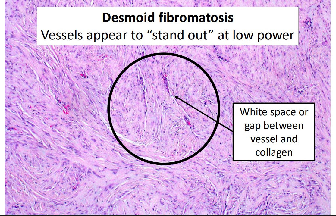 Janiranavarro's tweet photo. "Common" bland spindle cell lesions of the breast
Desmoid Fibromatosis

- Typically non-syndromic in breast
- Clinically and radiographically mimics carcinoma
- Trend towards conservative, non-operative approach with consideration of tyrosine kinase inhibitors
- β-catenin positive (up to 70%), but metaplastic carcinomas and fibroepithelial lesions may also show nuclear β-catenin labeling; always include cytokeratin IHC

Dr. Cimino-Mathews #USCAP #pathology #PathX #PathTwitter #Breastpath