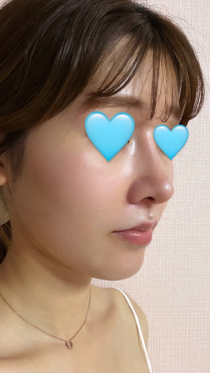 fAl6sJAKSw43130's tweet photo. ビギン美容外科で鼻整形してから3ヶ月が経ちました！！！
もうだいぶ腫れも引いてきて、すごく綺麗で大満足です🩵
形も理想で言うことないです🥹🫶🫶
イジュチョル院長に大感謝です！！！
#鼻整形
#ビギン美容外科
#鼻フル https://t.co/L5rJESYcEk