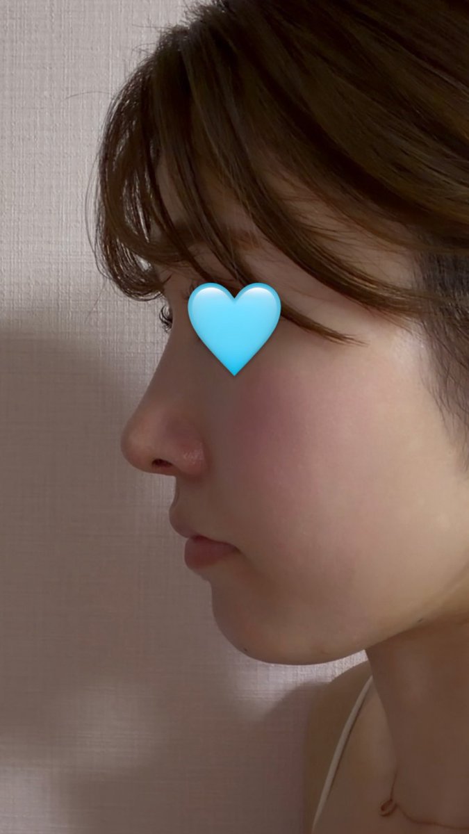 fAl6sJAKSw43130's tweet photo. ビギン美容外科で鼻整形してから3ヶ月が経ちました！！！
もうだいぶ腫れも引いてきて、すごく綺麗で大満足です🩵
形も理想で言うことないです🥹🫶🫶
イジュチョル院長に大感謝です！！！
#鼻整形
#ビギン美容外科
#鼻フル https://t.co/L5rJESYcEk