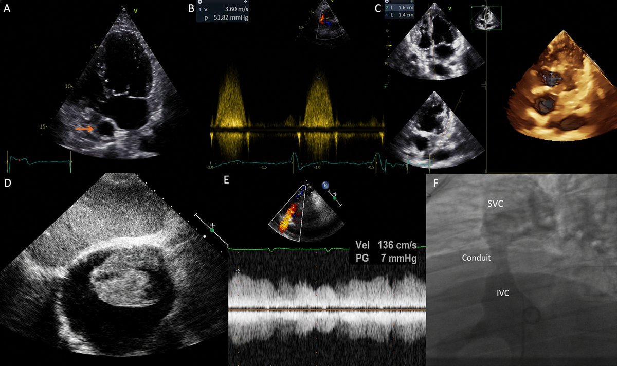 DeBakeyCVedu's tweet photo. Protein-losing enteropathy &amp; Fontan-associated liver disease are major multisystem complications needing active surveillance &amp; hemodynamic optimization

Single Ventricle Fontan: Basics for Genl Cardiologists-B Sarubbi
https://t.co/ogzDuBbgUv #DeBakeyCVJournal #ACHD @maquinonesmd https://t.co/q6zGweOZl6