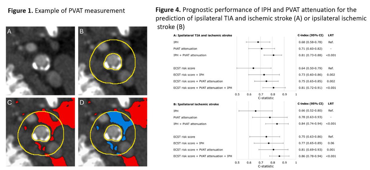 journalCCT's tweet photo. In this strong prognostic analysis by Bierens et al., PVAT attenuation was shown to be an independent marker for ischemic stroke and TIA risk in symptomatic patients, beyond stenosis and intraplaque hemorrhage. 

https://t.co/YwVXLxGQxp https://t.co/7rbsUVnJO4