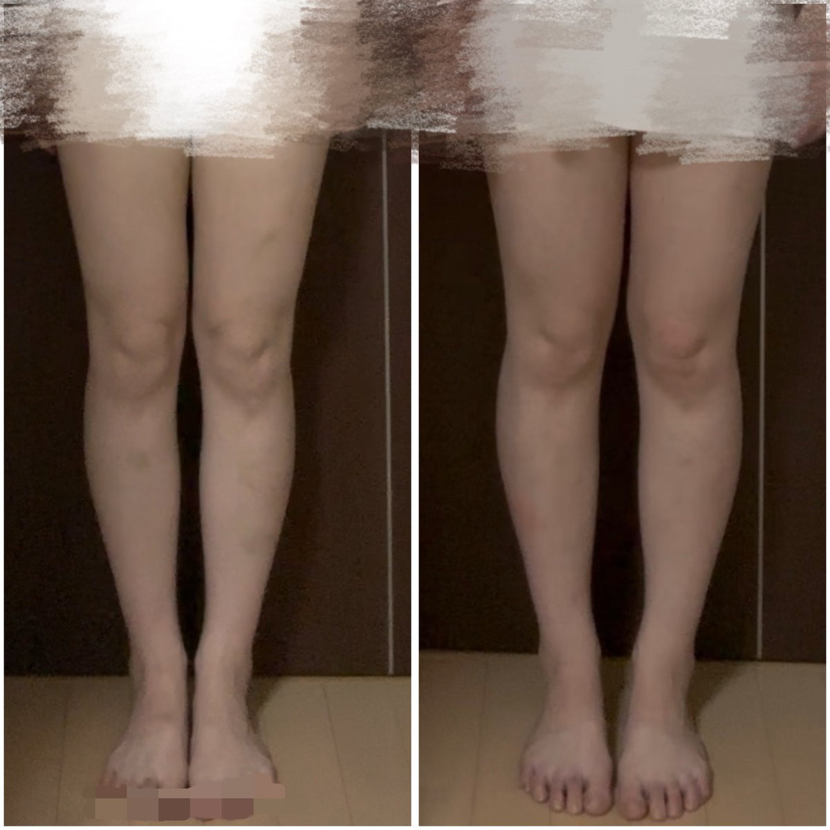 m0m_uqu's tweet photo. -6kgでこの変化😯上半身ほど分かりやすくは細くなってないけど並べてみると意外と差を感じてうれしい😆😆😆😆😆脚やせもっと頑張るぞー https://t.co/sCQ5UNtVLZ
