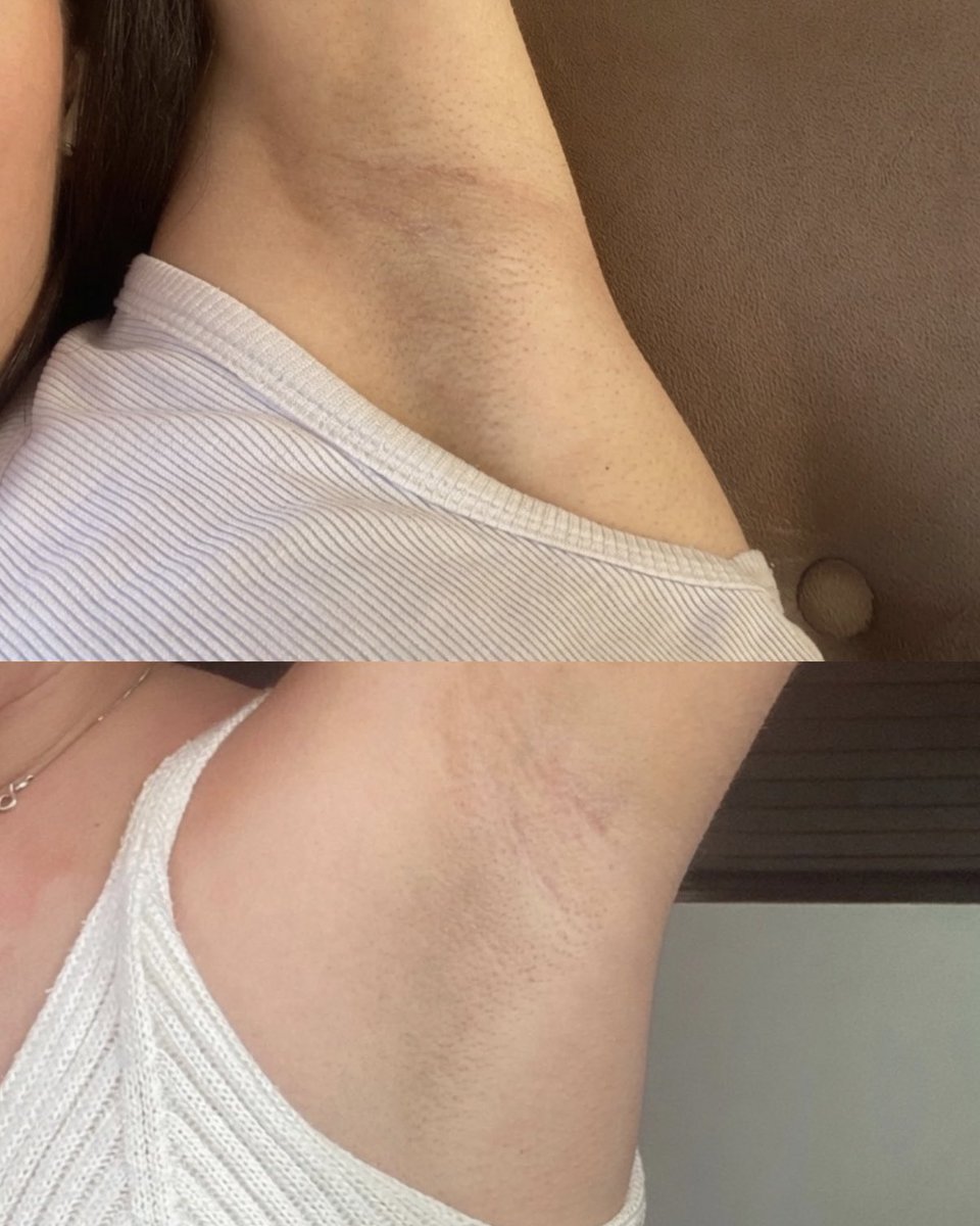 gabzklima's tweet photo. tô usando esse combo pra clarear meu sovaco e juro por deus eu tô em choque 😭 usei 3 vezes (nem foi em dias seguidos pra não sensibilizar a pele) e já consigo ver diferença. como ninguém fala mais disso?? https://t.co/JSo2515v4k