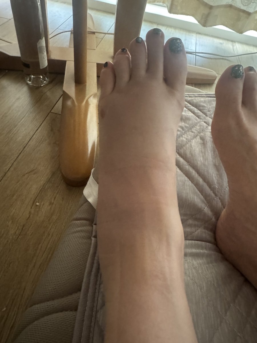 AniLexiFoot's tweet photo. New on FeetFinder! Sharing my real story: ankle fracture + torn ligaments journey 🩹
From first steps on crutches to real rehab moments.
3 exclusive albums with my raw recovery story are live! 👇
https://t.co/3HLoSq7R8W
#feetfinder #medicalfoot #footinjury #crutches https://t.co/L5t1D3MrS3