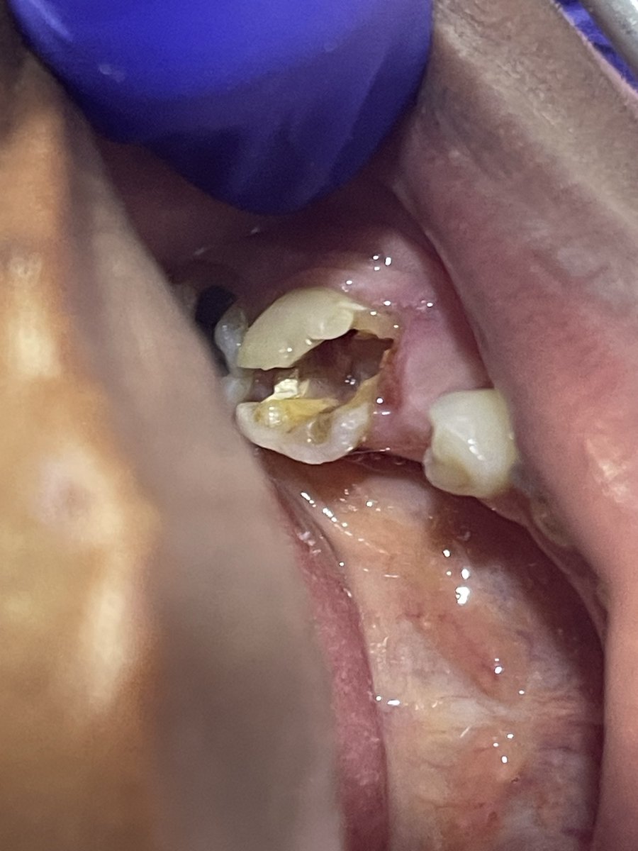 Simihdental's tweet photo. Notice the black filling on the adjacent! At Simih Dental Clinic, we DO NOT use black amalgam fillings.
📍 Douala Entre Johannesburg Kotto
📲 WhatsApp: 683028966 
📞 Call: 693325570
#SimihDentalClinic #DentalCare #Douala #ToothRestoration #BeforeAndAfter #OralHealth #ModernDentis https://t.co/BxhGLPHOZg
