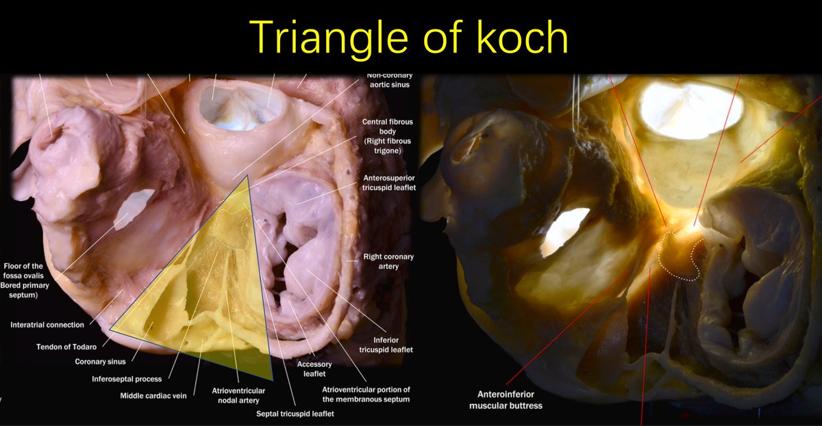 pzhong2016's tweet photo. Triangle of Koch https://t.co/C7fGzSwD6B