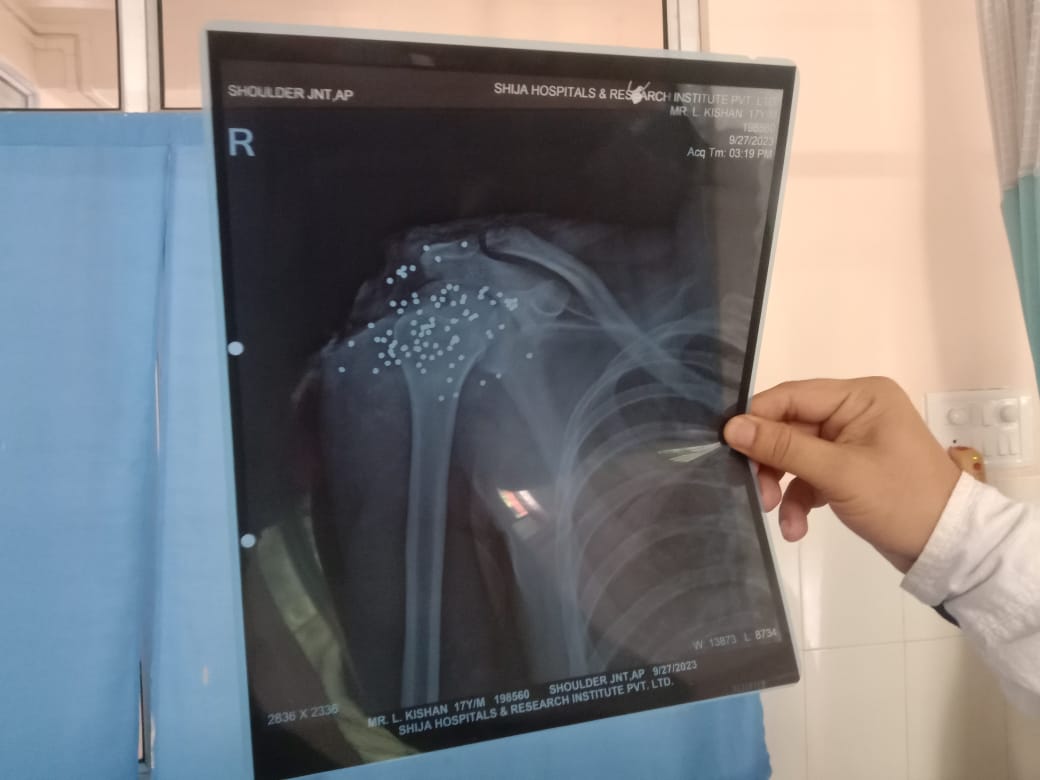 tweets_prateekg's tweet photo. In 2023, I  reported from #Manipur regarding  #pellet gun injuries suffered by 17 yr old Kishan Loitongbam. He was a class 12 student in Imphal who took part in a school students protest, after two fellow students went missing and were later found dead. Kishan was shot with a #pellet gun by RAF personnel at point-blank range in his right shoulder. His shoulder was shattered. Doctors told me that there were around 90 pellets lodged in his shoulder, but they could remove only 60.

Another , 17 yr old student, Soaibam Uttam, suffred pellet injuries to his head. More than 50 pellets were lodged in the back of his head. Along with them, six more school students suffered pellet injuries. All eight of them were minors. At that time, Kishan's father asked me ," The RAF could have used water cannons or carried out a lathi charge to disperse the students. Why did they have to use pellet guns against student protesters?Have #pellet guns ever been used against school students protesting in #Delhi, #Mumbai or other parts of mainland India? Then why only in Manipur?"

I had answered him 'no' back then. But three years later, pellet guns have also been used against protesters in #Delhi, may be not on minors, but definitely people participating in a student  protest.

If the police alone get to decide what is an "exceptional situation," then doesn't every situation become exceptional whenever they want to justify the use of #PelletGuns?

Given below are the then X-rays of the pellet injuries suffered by  Kishan and Soaibam.