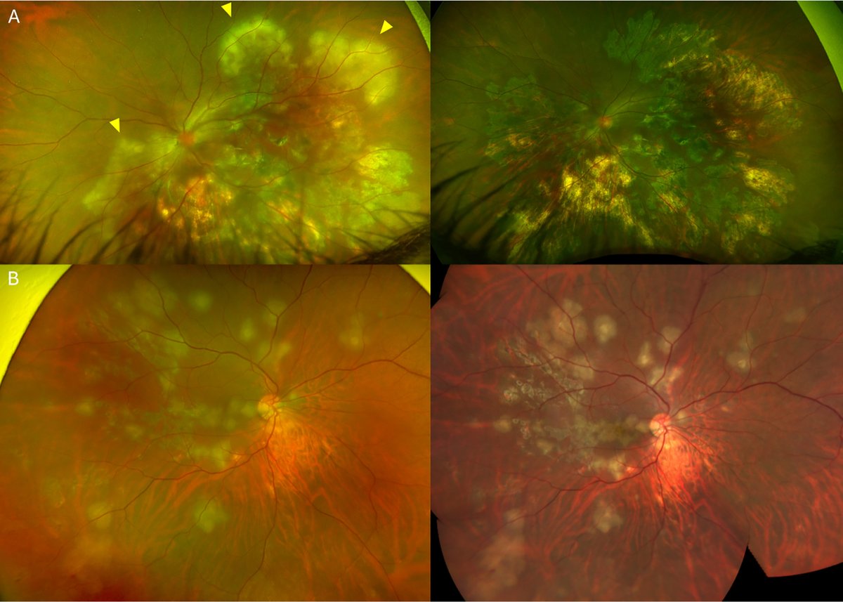 AAOjournal's tweet photo. Evidence and Consensus Based Guidelines for Imaging in Tubercular Choroiditis. Multimodal imaging in Uveitis (MUV) Taskforce: Report 17
https://t.co/4u0aH6QJw5
@aniruddha9
#ophthalmology https://t.co/8FLpq07fSA