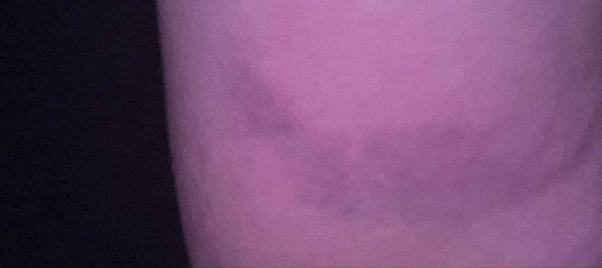forgottensinns's tweet photo. I went in the bathroom to close the window but it was too far out so I had to jump to close it and hit my arm hard now by accident I have a bruise that hurts like shit 

It’s kinda shaped like a boat tho 🤔🤔 https://t.co/ZN4nLVgSsl