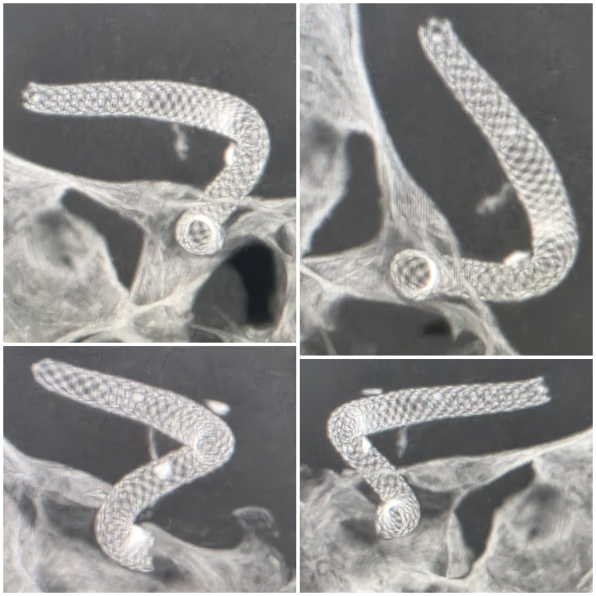 SharathKumarGG7's tweet photo. #FlowDiverter #Aneurysm #BrainAneurysm #Endovascular #Neurointervention 
@ManipalHealth https://t.co/1Vo9tgMxY6