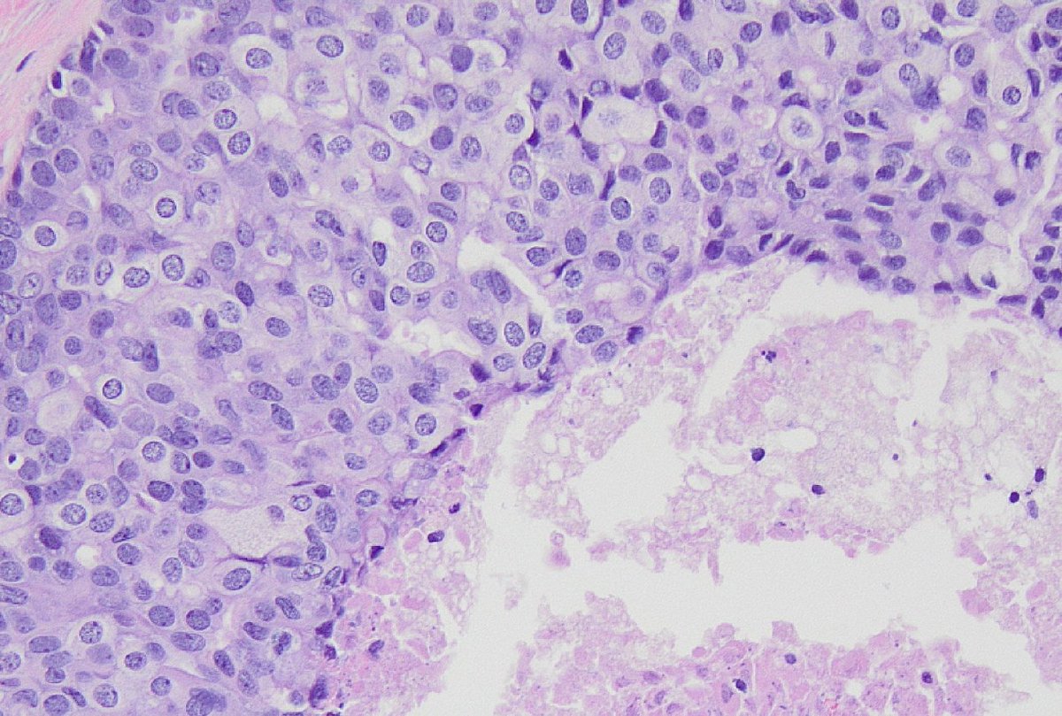 mhassanaimc's tweet photo. This was called High-grade DCIS with comedo necrosis on stereotactic biopsy. You guys agree?

If you agree. There will be lumpectomy/mastectomy with sentinel lymph node and followed by radiation

If you disagree: Patient will go home. No surgery needed #breastpath https://t.co/YYyCfRrt5M