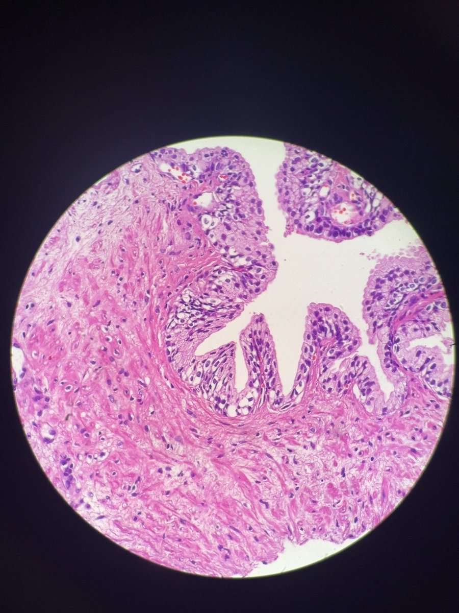 drtugcecay's tweet photo. What do you think of these cells in prostate? #uropath #pathology #prostatepathology #pathx #pathtweet https://t.co/i0Vv5fdj0x