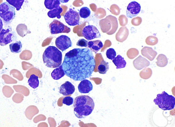 smbenlazar's tweet photo. Sea blue histiocyte | ASH Image Bank | American Society of Hematology https://t.co/S8USZhfVX2 #ASHImageBank https://t.co/LmsVH04n0s