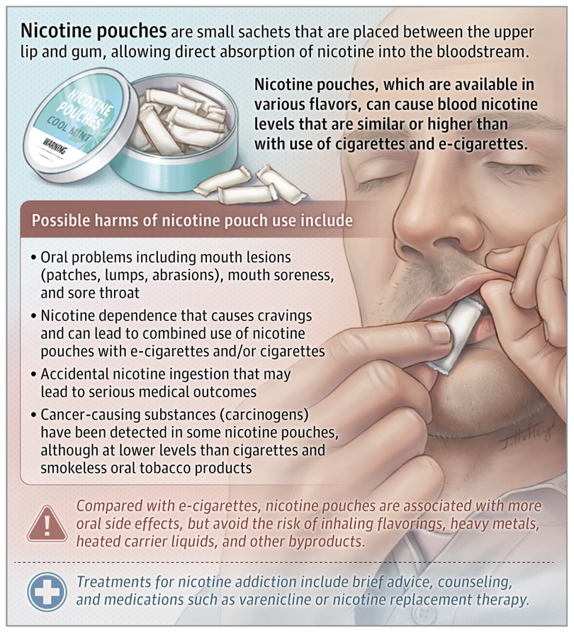 JAMA_current's tweet photo. 📝 JAMA Patient Page: #NicotinePouches can cause oral problems, nicotine dependence, and accidental nicotine ingestion, while long-term health effects remain unknown. 

https://t.co/PKxk7wmQjt https://t.co/HIgfq9YPqX