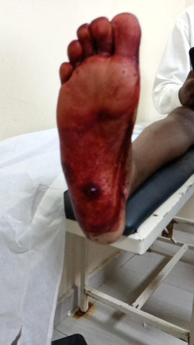skudimayer's tweet photo. Un miembro de la @PoliciaRD propinó un disparo en un pie a un menor de edad luego que este no hizo caso a un llamado de pare durante un operativo en la carretera Sanchez próximo al Portón de el Llano @pesqueiradiego @super7fm @OlivoGust @elnuevodiariord @ElDia_do.

 👁 al Cristo https://t.co/S53oUagJrk
