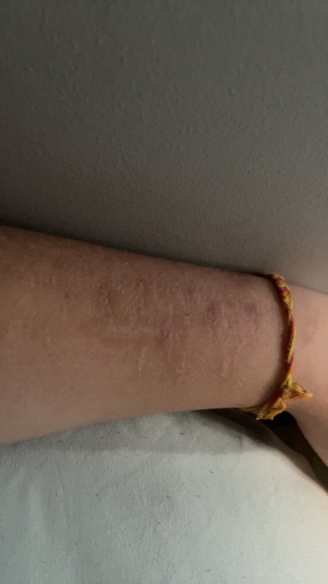 arrow_cook's tweet photo. Scars https://t.co/EXU22OYCrg