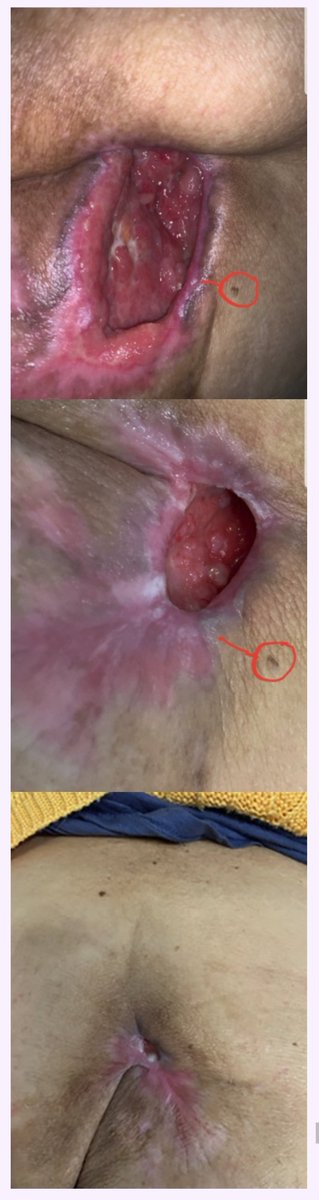 Stan82Stan's tweet photo. @ZakariaMDv3 7 day wound healing in cases of chronic wounds, diabetic foot and advanced atherosclerosis https://t.co/x65TUaf4ly