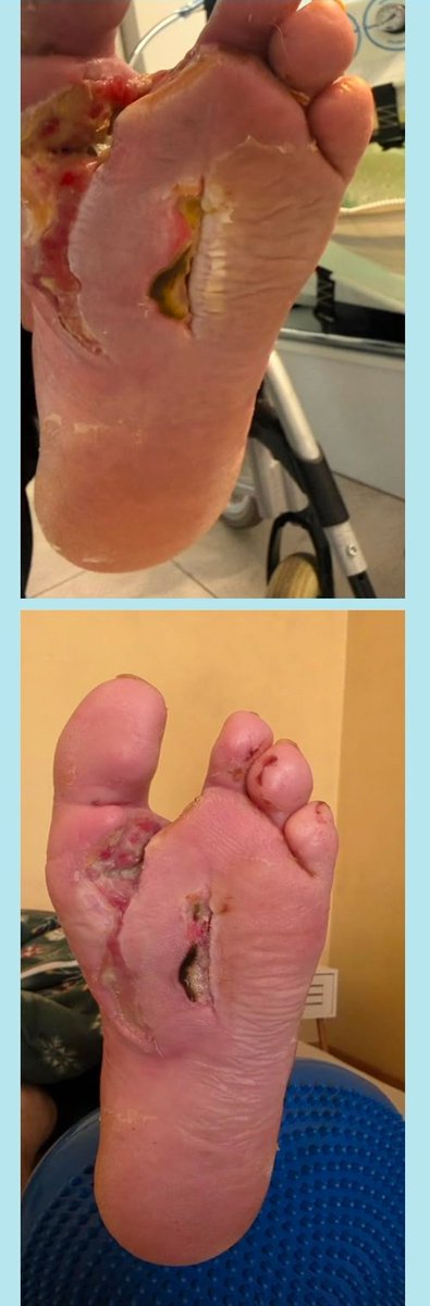 Stan82Stan's tweet photo. @ZakariaMDv3 7 day wound healing in cases of chronic wounds, diabetic foot and advanced atherosclerosis https://t.co/x65TUaf4ly