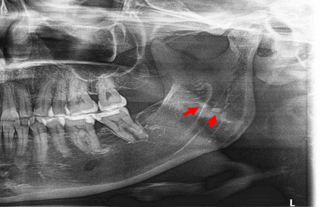 dentometric's tweet photo. magen radiopaca proyectada en la rama ascedente mandibular

Enlace: https://t.co/y0QRMbhTwK https://t.co/cSnCDBpRDk