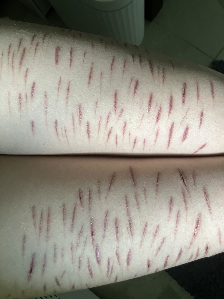 hopeingtime56's tweet photo. scars from the famous sesh. see if u can spot any you knoow! :)

they look so weak, i feel invalid.

ALL HEALED, NOT ENCOURAGING ANY HARM THIS IS SCARRING
#scarspo #shhtwt #edrtwt #beanstwt #styrotwt https://t.co/u88u4sMqy7
