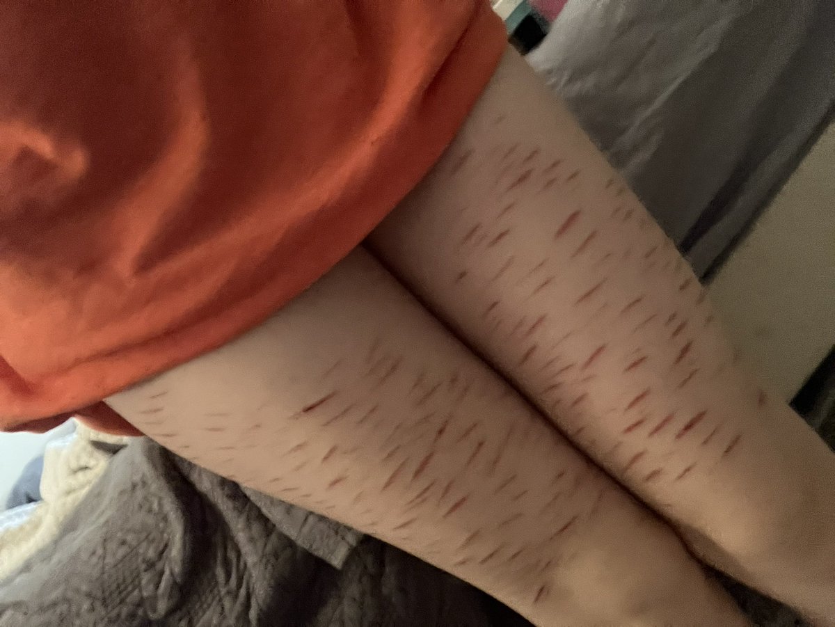 hopeingtime56's tweet photo. scars from the famous sesh. see if u can spot any you knoow! :)

they look so weak, i feel invalid.

ALL HEALED, NOT ENCOURAGING ANY HARM THIS IS SCARRING
#scarspo #shhtwt #edrtwt #beanstwt #styrotwt https://t.co/u88u4sMqy7
