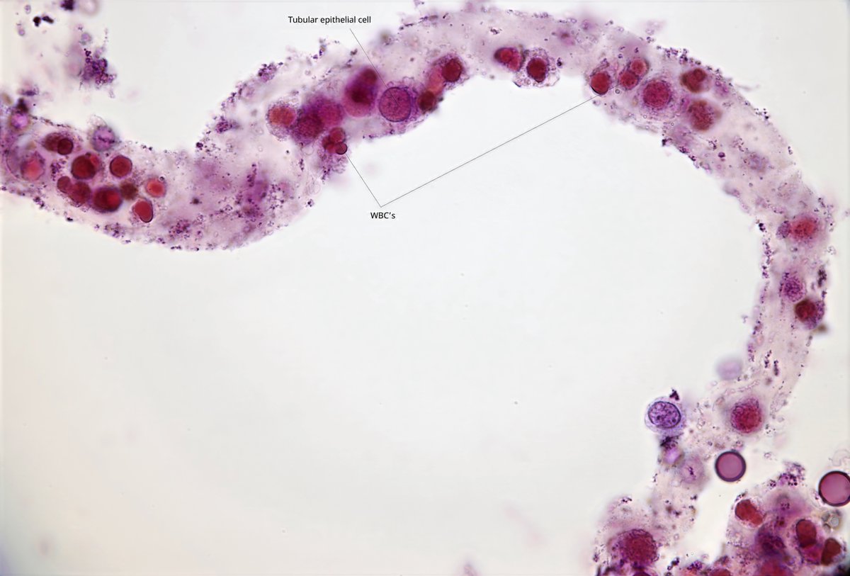 jrseltzer's tweet photo. Mixed cellular cast - brightfield, with SM stain - from patient with hemoptysis, AKI, and + ANA and ANCA - #UrineMicroscopy #UrinarySediment https://t.co/yBf7xwx7tc