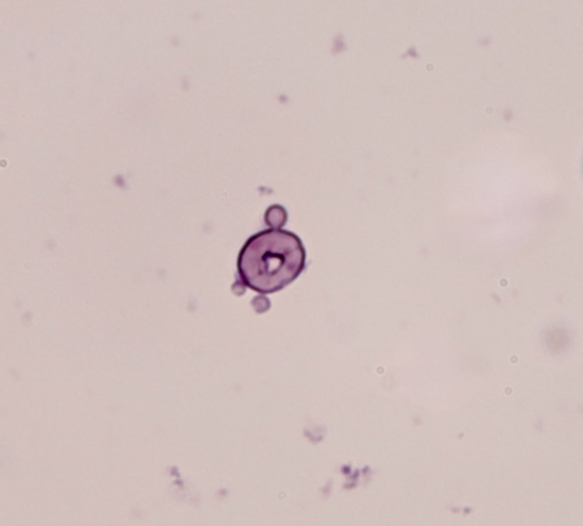 jrseltzer's tweet photo. Acanthocyte - brightfield, with SM stain - from patient with hemoptysis, AKI, and + ANA and ANCA - #UrineMicroscopy #UrinarySediment https://t.co/5oke4RRvRV
