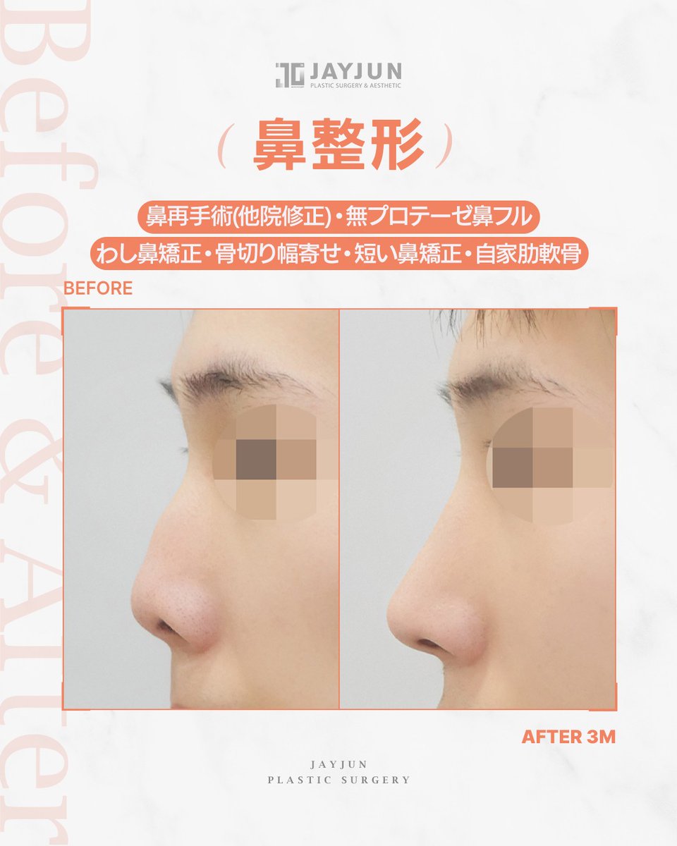 jayjun_jpn's tweet photo. ✦ JAYJUNメンズ鼻再手術｜他院修正｜無プロテーゼ鼻フル ✦

『鼻筋が太く見えて、横顔がすっきり見えなかった』
『鼻先が短く、全体的に鼻が詰まって見えるのが気になっていた』

今回の症例は、
他院修正／無プロテーゼ鼻フル。

わし鼻矯正・骨切り幅寄せ・短い鼻矯正を行い、
自家肋軟骨を使用して、鼻筋から鼻先までのラインを再設計しました。

プロテーゼを使用せず、
もともとの骨格・皮膚の厚み・お顔全体のバランスに合わせて整えることで、
派手すぎない自然な横顔へ。

術後3ヶ月の時点でも、
鼻筋の幅感と鼻先のラインが整い、
横顔の印象がよりすっきりと変化しています👃🏻✨

鼻再手術は、
「高さを足し直す手術」ではありません。

前回の違和感の原因を見極め、
鼻筋・鼻先・鼻孔・横顔のラインを
もう一度、構造から整える手術です。

別角度の症例写真は画像でご確認ください。

━━━━━━━━━━━━━━━━
🏥 JAYJUN美容外科｜ソウル江南
🇯🇵 日本人通訳常駐
📩 LINE：https://t.co/5uZjGbmAmQ
━━━━━━━━━━━━━━━━

※腫れ・仕上がり・ダウンタイムには個人差があります。

#鼻再手術 #鼻修正 #他院修正 #無プロテーゼ鼻整形 #わし鼻矯正 #骨切り幅寄せ #短い鼻 #メンズ鼻整形 #男性鼻整形 #韓国鼻整形 #江南美容外科 #渡韓整形