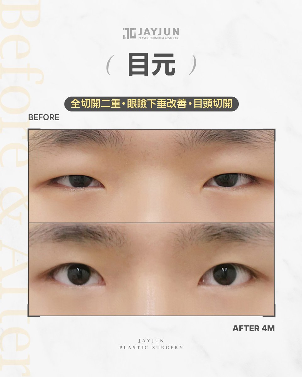 jayjun_jpn's tweet photo. ✦ JAYJUNメンズ目元整形｜全切開二重｜眼瞼下垂改善 ✦

「眠そうに見える」
「目が重たく、黒目が隠れて見える」

男性の目元整形で大切なのは、
二重幅を広げることではなく
目の開き・黒目の見え方・左右バランスを整えること。

今回の症例は
全切開二重＋眼瞼下垂改善＋目頭切開。
術後4ヶ月の経過です。

派手さではなく、
視線が自然にはっきり見える目元へ。

#眼瞼下垂改善 #全切開二重 #メンズ二重 #メンズ目元整形 #眠そうな目 #目の開き #黒目が隠れる #二重整形 #韓国整形 #江南美容外科
