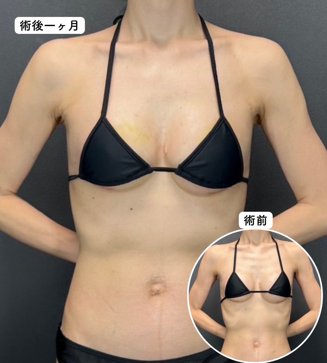tomitasakura_dr's tweet photo. シリコンバッグ豊胸後のシリコンの浮きが気になる方は、
後からハイブリッドがおすすめです！
　
すでにシリコンが入っているため、
脂肪の採取量・注入量は通常の脂肪豊胸とは異なります。
　
こちらの患者様も、シリコンバッグ豊胸後のシリコンの
浮きが気になるとご相談いただきました。
　
術前に気になっていたデコルテのゴツゴツ感やシリコンの浮き感を、
脂肪注入でデコルテをふんわり整えることで、不自然さが消えて
より自然で女性らしい印象に仕上がります✨