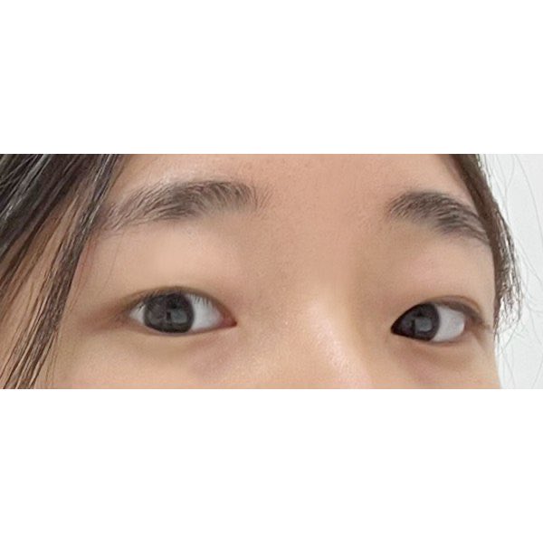 ctjy_o's tweet photo. #TOBE美容外科 手術レポ📝

自然癒着とか軽い二重整形するつもりだったんだけど、目の開き悪めだから目を開ける力も改善したほうがいいっていわれて目つき矯正に👀

まだ２か月も経ってないから腫れ残ってるけど黒目の見え方が全然違う🥹目の開きもめちゃ良くなった！
まだ経過中だから完成楽しみ😻 https://t.co/aGpPTTuM1u