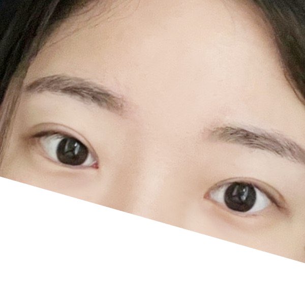 ctjy_o's tweet photo. #TOBE美容外科 手術レポ📝

自然癒着とか軽い二重整形するつもりだったんだけど、目の開き悪めだから目を開ける力も改善したほうがいいっていわれて目つき矯正に👀

まだ２か月も経ってないから腫れ残ってるけど黒目の見え方が全然違う🥹目の開きもめちゃ良くなった！
まだ経過中だから完成楽しみ😻 https://t.co/aGpPTTuM1u