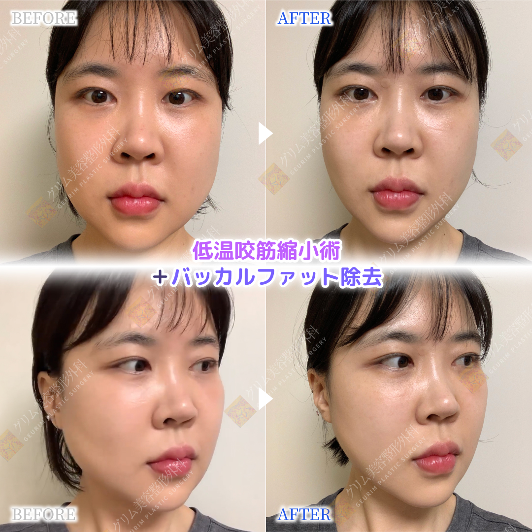 geurimjp's tweet photo. もう何度打ったかわからない！ボトックス依存から卒業しませんか？🎓✨

エラボトックスの効果が切れるたびにクリニックへ通う… そんな日々はもう終わり！ 

 💡「低温咬筋縮小術」と「エラボトックス」の違いは❓
💉エラボトックス: 
筋肉の動きを一時的に止めるだけ。数ヶ月で元通り💦

🧑‍⚕️低温咬筋縮小術: 
高周波で筋肉細胞そのものを凝固・縮小！半��久的な効果が期待できます。何度も通う必要がないためコスパも抜群💰✨

✨ 低温高周波咬筋縮小術のポイント❣️
💎60〜80℃の低温方式: 
熱損傷が少なく、主要な神経や血管を傷つけるリスクが極めて低いです。
💎ダブル効果: 
筋肉縮小＋枝神経遮断で頬のコケを防ぎ、再発達を抑制！
💎傷跡ゼロ・当日帰宅: 
口の中からアプローチするので外側に傷跡は残りません。抜糸も不要！

💡 20代で「バッカルファット×低温咬筋縮小術」を受ける人が急増中❣️

1️⃣ 筋肉＆脂肪のダブルアプローチエラ（筋肉）とバッカルファット（脂肪）を同時にケアして、どこから見てもシュッとしたVラインに！ 🥰

2️⃣ 将来のたるみ予防！頬の奥の脂肪（バッカルファット）は加齢とともに垂れてほうれい線やブルドッグ顔の原因に。20代のうちに予防��ることで、30代・40代でもすっきりフェイスラインをキープできます✨

日本人ス��ッフ常駐で、カウンセリングからアフターケアまでしっかりサポートいたします。
根本的にエラを解消したい方、ぜひお気軽にご相談ください💌

ご予約・お問い合わせはプロフィールのURLから公式LINEへ📲  ID: grkoojp https://t.co/yvQL6PhVus

#韓国美容 #韓国整形 #グリム美容整形外科 #美容整形 #エラ #小顔 #小顔整形 #フェイスライン #ボトックス #咬筋縮小 #バッカルファット #たるみ予防 #美容垢 #美容好きさんと繋がりたい #Ｖライン #フェイスリフト #渡韓整形 

 https://t.co/rTuthqDyRa #Amebaブログ #アメブロ