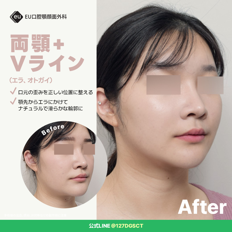 Eujapan2's tweet photo. 【症例写真】両顎 ＋ Vライン

「顔の余白が多く、垢抜けない印象を改善したい！」とご来院された患者様。お顔のパーツがより綺麗に引き立つようになりました💡

✅顎先からエラにかけて、滑らかなラインを構築
✅中顔面の立体感を活かす
✅やりすぎ感を出さず、ナチュラルな仕上がり
✅どこから見ても、自然で上品な小顔へ

両顎手術は見た目の変化量だけでなく、顎の骨を本来の正しい位置へ整えることで【機能面×審美面】をW改善できる手術です。

手術が適応かどうか、まずはカウンセリング！
https://t.co/PLVBsr7OYh

#ルフォー #SSRO #口ゴボ #しゃくれ顎