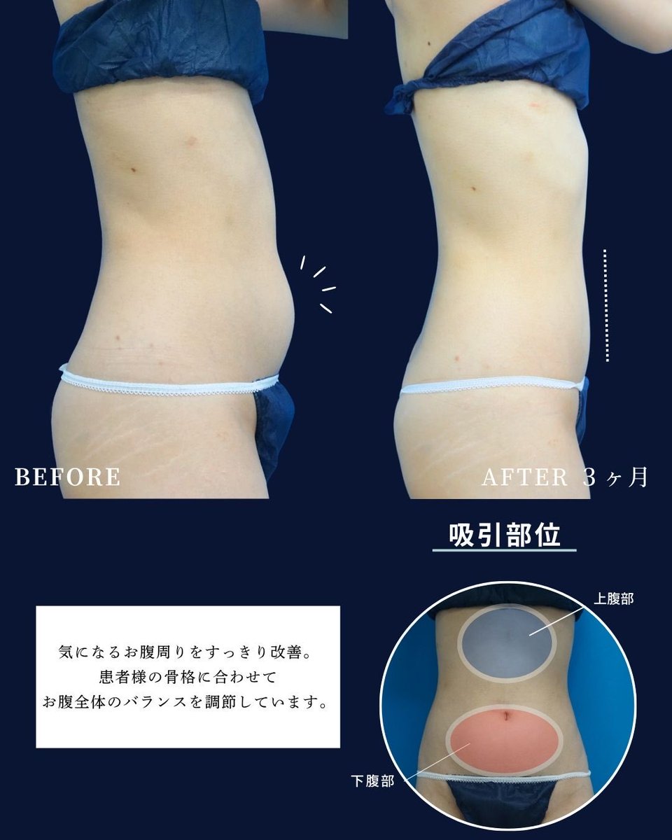 GardenClinicNet's tweet photo. 20代女性：術後3ヶ月 
施術内容：お腹の脂肪吸引 
注意事項：腫れ、浮腫み、内出血 
●1部位 部分モニター220,000円 
●アキーセル1部位 通常料金+55,000円 
●VASER1部位 通常料金+55,000円 
↓脂肪吸引の詳細はこちらをチェック 
 https://t.co/4uppQUdJO4 https://t.co/Ez8iCZupy1