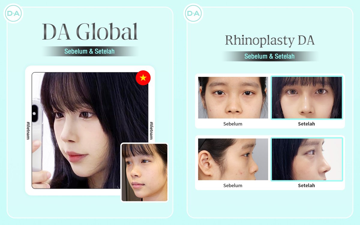 daprs_indo's tweet photo. ✨[Rhinoplasty DA]��
Lihatlah perubahan yang signifikan model DA setelah melakukan operasi hidung di D.A!
Di D.A dijamin aman, hasilnya naturan dan cantik untuk enhance penampilan wajahmu! https://t.co/buLBE08ofZ