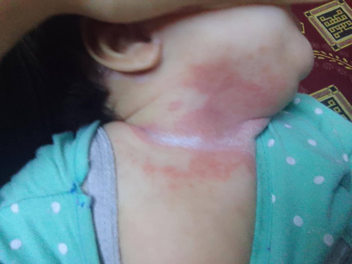 yousefQasem1998's tweet photo. 💔 My little girl is burned… the burns on her neck and knees are getting worse every day 😢
My heart is breaking seeing her like this, and I can’t afford her treatment 💔 https://t.co/oXuNDpYUbH