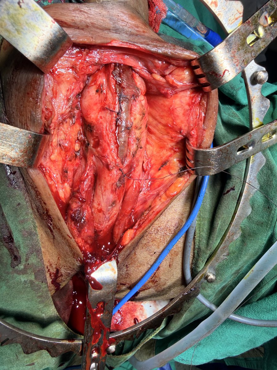 Prezz1305's tweet photo. Urology me stricture disease bahat common hai , aise me agar long segments urethral stricture ho to problem ye hota hai ki kaise long segment graft le, yaha maine ek spiral graft use kiya jo ek best alternative deta hai , pt ka outcome bhi achha https://t.co/TkerCzFR5d