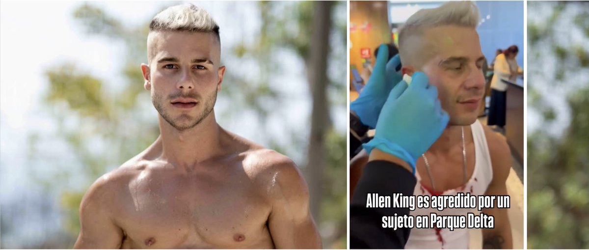 PinkTVFR's tweet photo. Agression dans un café ! Allen King en sang après qu’un inconnu lui a violemment jeté une tasse au visage. Super porn star, chanteur et influenceur gay, l’Espagnol est sûr que son agresseur était motivé par l’homophobie. Il porte plainte… 

—>> https://t.co/GJuyEK7JNW https://t.co/mgiKY3Kqub