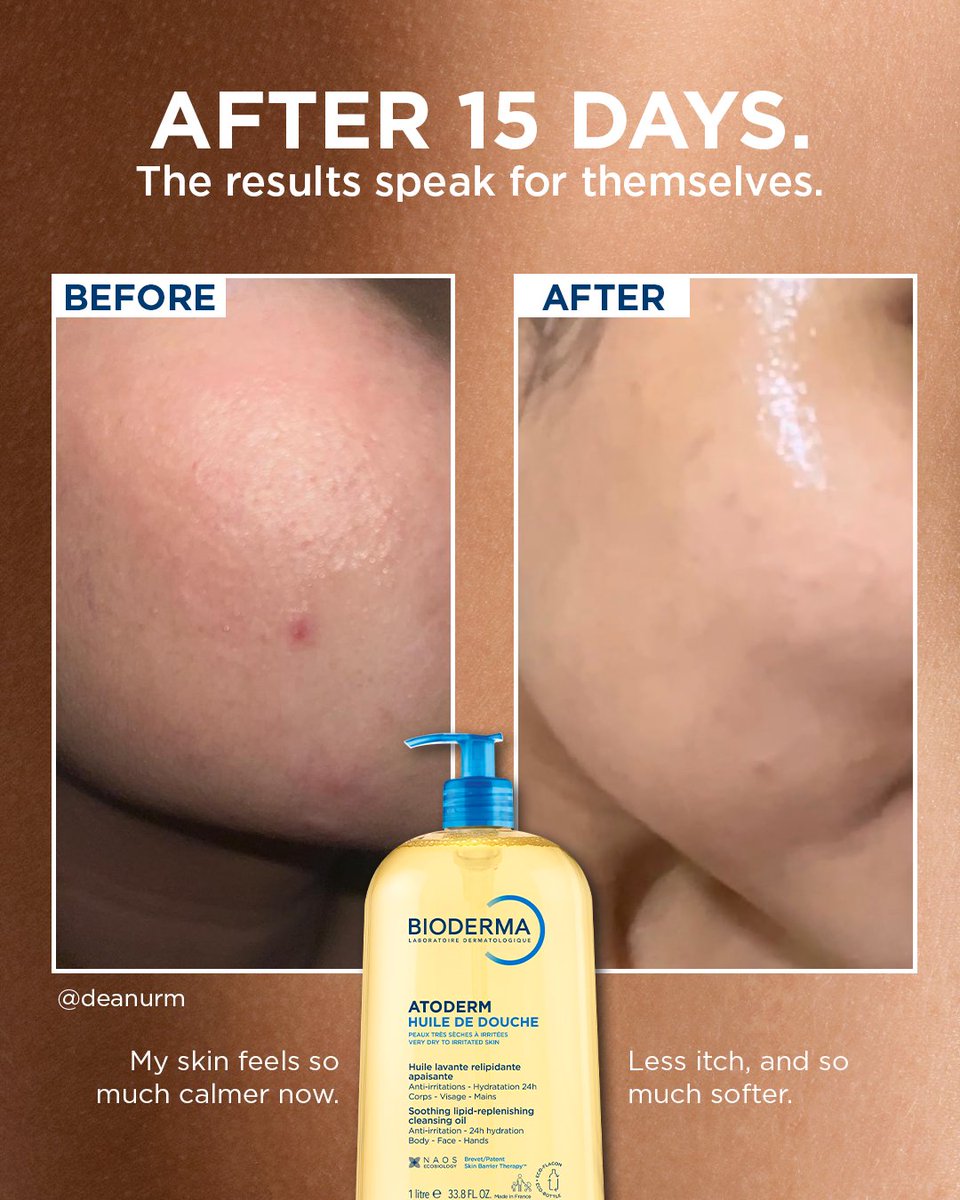 Bioderma_ID's tweet photo. 15 days later, their skin said everything. 🤍
Less redness, less itch, softer skin, and a barrier that finally feels like itself again.

Swipe to see what 15 days can do.
 
#SkinReset #YourRealSkinUpgrade #dermsolutions #biodermaindonesia https://t.co/F7yKoI8v1m