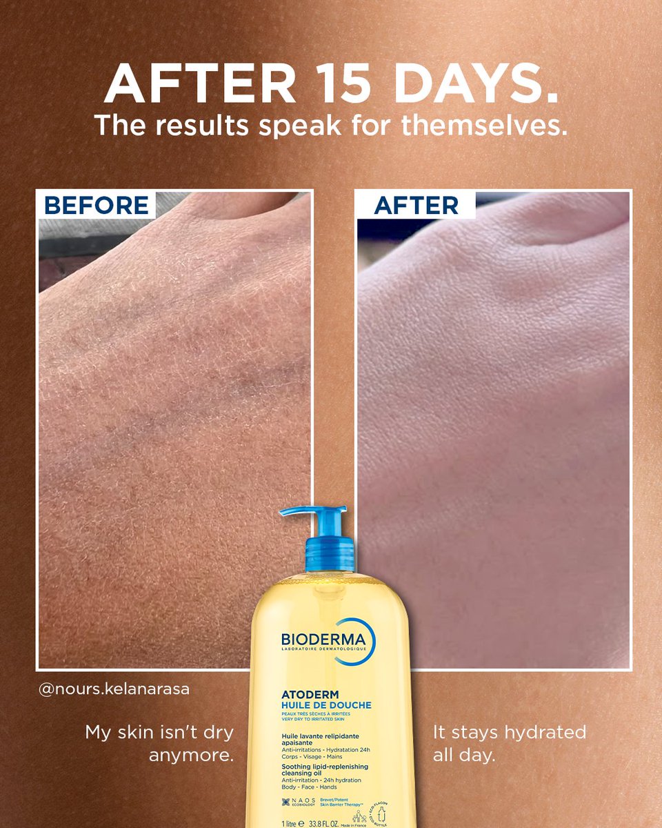 Bioderma_ID's tweet photo. 15 days later, their skin said everything. 🤍
Less redness, less itch, softer skin, and a barrier that finally feels like itself again.

Swipe to see what 15 days can do.
 
#SkinReset #YourRealSkinUpgrade #dermsolutions #biodermaindonesia https://t.co/F7yKoI8v1m
