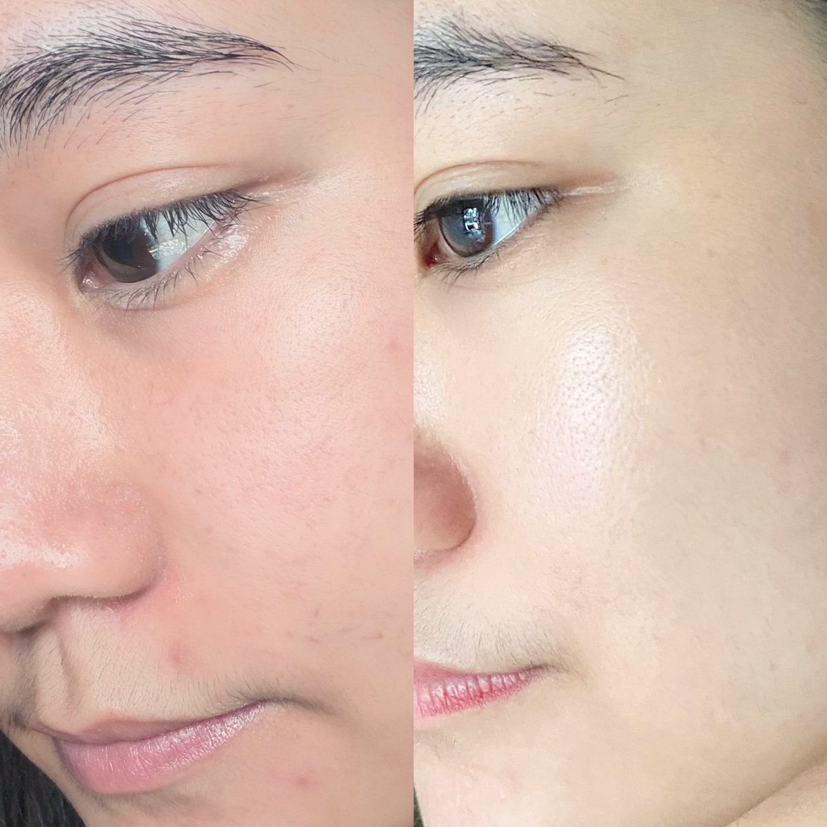 BBEZNZ's tweet photo. ลองใช้ @SkintificTH PDRN Serum ต่อเนื่องแล้วรู้สึกว่าผิวดูอิ่มน้ำขึ้นจริงๆอะ รอยสิวยังไม่ได้หายหมด แต่ผิวดูละเอียดขึ้นมากกก เวลาแต่งหน้าคือให้ฟีลผิวสวยกว่าเดิมแบบสังเกตได้ชัด 🫶🏻
นี่ไม่ได้เป็นคนผิวดีอยู่แล้วเลยรู้สึกว่าตัวนี้ช่วยเรื่อง ผิวดูโทรมน้อยลงมากกว่า พอตื่นเช้ามาหน้าไม่แห้ง ไม่หมองเหมือนช่วงก่อนใช้ ละกลิ่นหอมอ่อนๆ คือถูกต้องมาก!💖