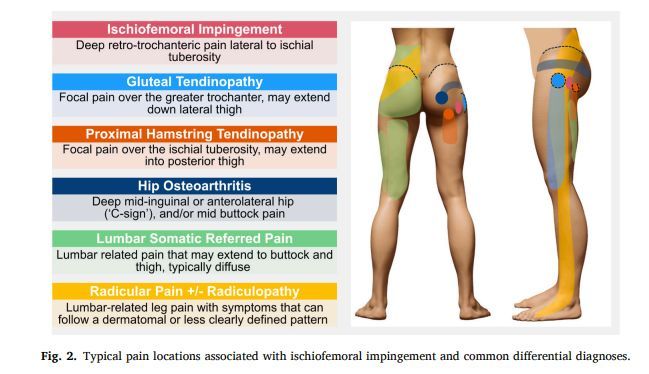 MSKPhysioJnl's tweet photo. 💡#Masterclass - 🟢 OPEN ACCESS - Check out our NEW masterclass on Ischiofemoral Impingement -  https://t.co/ZJWPl44KIp - #hip #ischiofemoral #impingement #assessment #rehabilitation https://t.co/lmfsDIwIPN